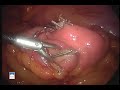 Laparoscopic Duodenal Switch - Dr. Smith