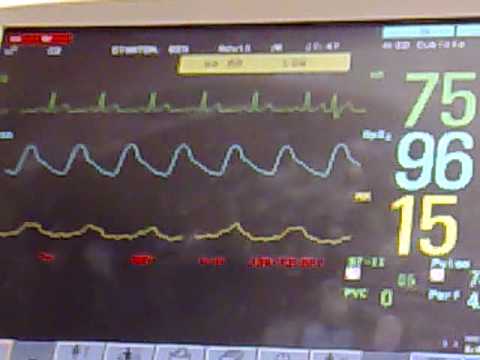 how to control pvc heart