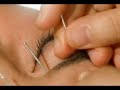 Facial Acupuncture Facial Acupuncture