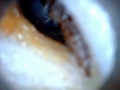 Wax Removal stopped  aching Jaw