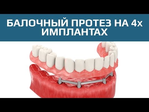 Балочных протез на 4х имплантах