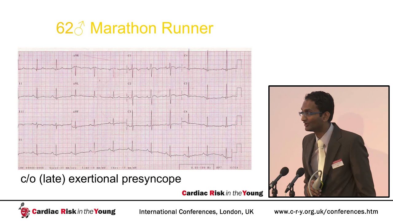 Investigation and management of the slow heart: Physiology vs pathology