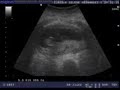 Nuevo integrante de la familia Sin Nombre Virus Infection
