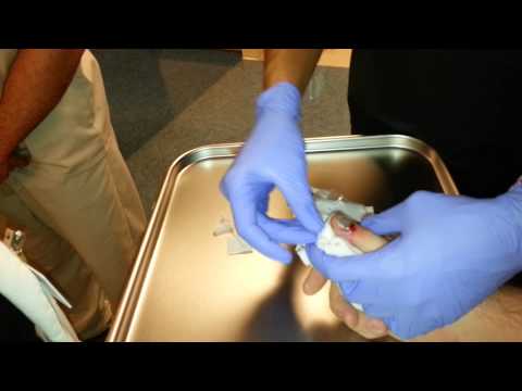 how to drain smashed finger