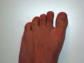 How To Treat Toenail Fungus, Natural Toenail Fungus Cure