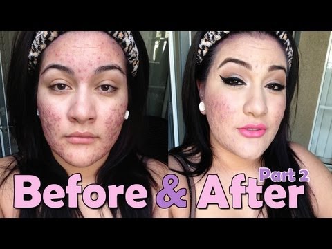 Foundation Routine for SEVERE Acne [PART TWO]