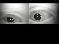 Tulsa Nystagmus 3