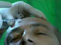Facial Rejuvenation with Jalupro