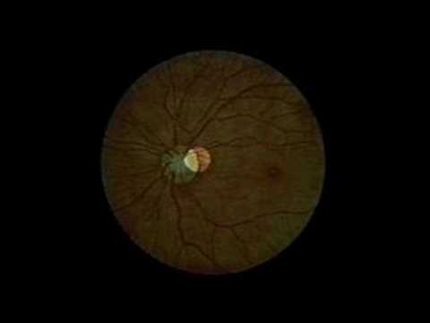Fundoscopy examination