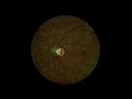 Fundoscopy examination Fundoscopy examination