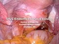 Endometriosis Resection – SILS Technique Endometriosis Resection – SILS Technique