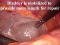 Laparoscopic Ureteral Reimplantation