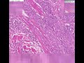 Histopathology Urinary bladder--Transitional cell carcinoma