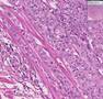 Histopathology Urinary bladder--Transitional cell carcinoma