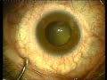 Challenging Cataract surgeries