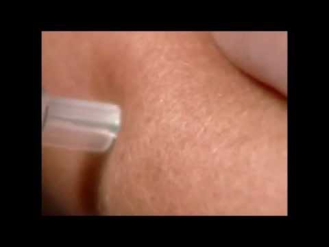 how to administer lupron