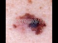 RAFT - skin cancer