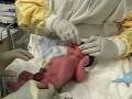 Birth of my baby by caesarean section