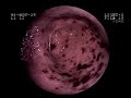 2) Endoscopy : Gastritis hemorrhagic 2) Endoscopy : Gastritis hemorrhagic