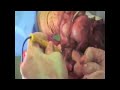 Dr. James Wittig: Radical Resection of Distal Femur [Part 2]