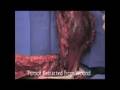 Dr. James Wittig: Radical Resection of Distal Femur [Part 2]