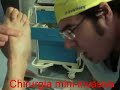 Chirurgie mini-invasive du pied