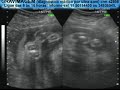 GRAVIMAGEM 953 (ULTRA-SOM 3D 4D GRAVIDEZ 24  SEMANAS)