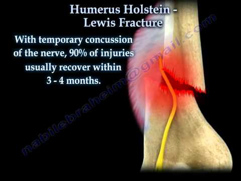 adecco+paperless+time Distal Humerus Spiral Fracture humeral shaft fractures - trauma ...