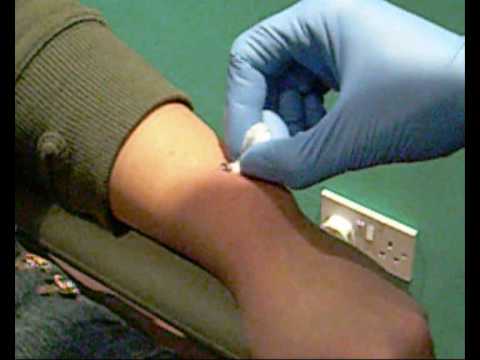 2011 Microdermal Piercing microdermal piercing removal. 2011 Microdermal Piercing