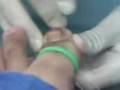videos de Video Thumb Toenail removal (3 of 3)