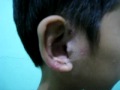 Skin infection,Mamaso