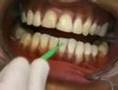 collage des brackets