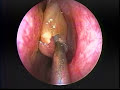 Endoscopic Nasal Polypectomy Endoscopic Nasal Polypectomy