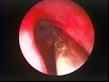 Edoscopic Treatment of a Large Left Frontal Sinus Mucocoele