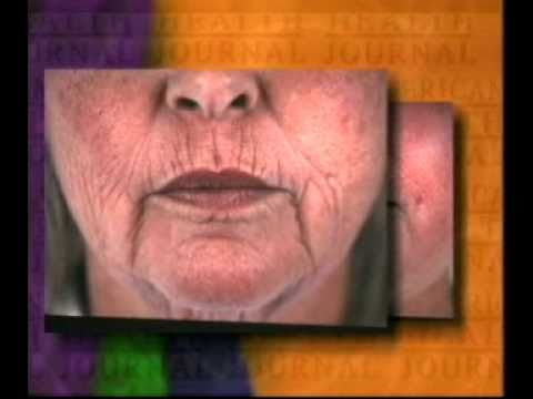 Botox and Laser Resurfacing.mp4
