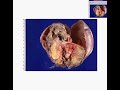 Histopathology Testis --Benign teratoma Histopathology Testis --Benign teratoma