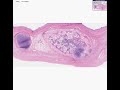 Histopathology Testis --Benign teratoma