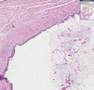Histopathology Testis --Benign teratoma