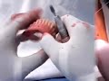 Cirurgia para soltar segmento preso ao osso