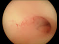 Intrauterine Pathology
