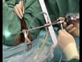 Intrauterine Pathology