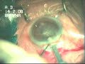PHACO IN HAZY CORNEA BY DR BHAVNA PHACO IN HAZY CORNEA BY DR BHAVNA