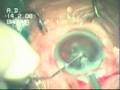 PHACO IN HAZY CORNEA BY DR BHAVNA