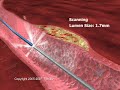 Medical Animation - Stent Procedure how a stent is used, 3d heart Medical Animation - Stent Procedure how a stent is used, 3d heart