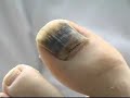 Toe Nail Fairy
