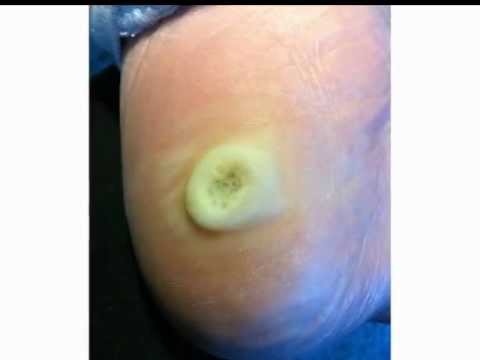 how to cure plantar wart