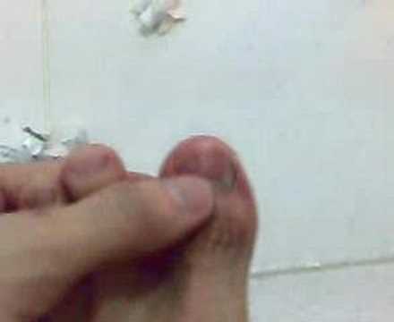 how to drain blood from under toenail