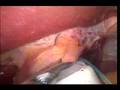 Lap-band_gastrogastric suture#2