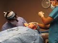 Simoni Lift, The Face lift of the Future, Actual procedure Simoni Lift, The Face lift of the Future, Actual procedure