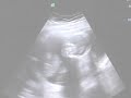 17 tydzień (17 weeks) USG Ultrasound